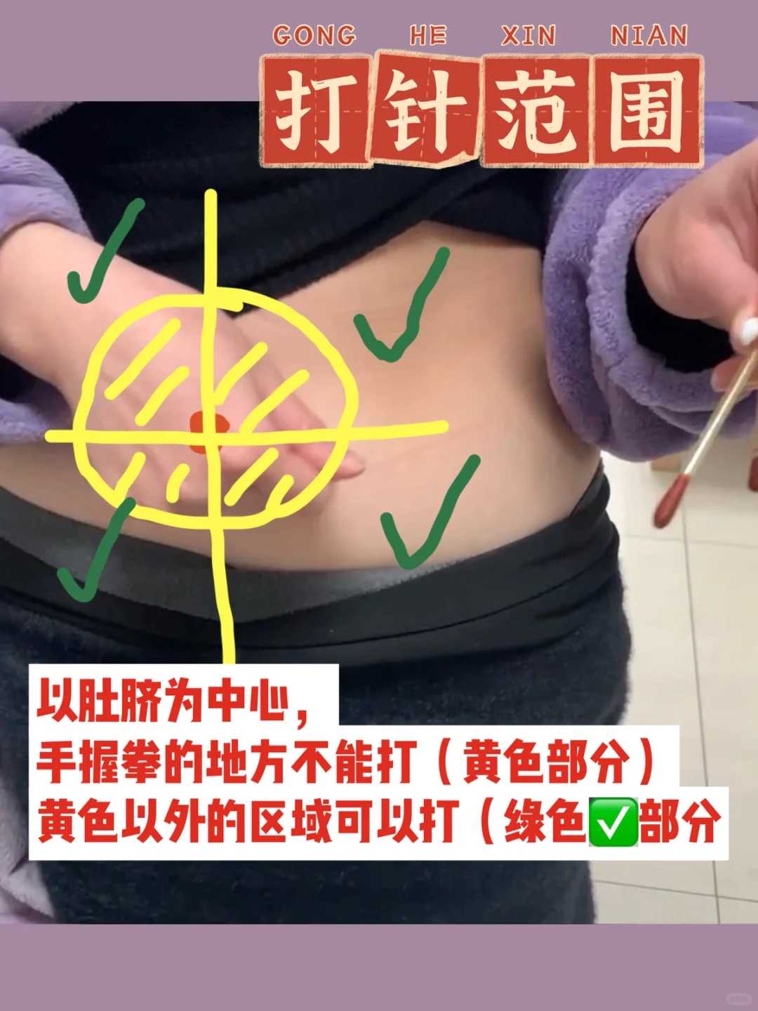 国内正规代生&试管代怀包生子,双侧卵巢多囊样改变怎么治疗(双侧卵巢多囊样改变可以正常怀孕吗)